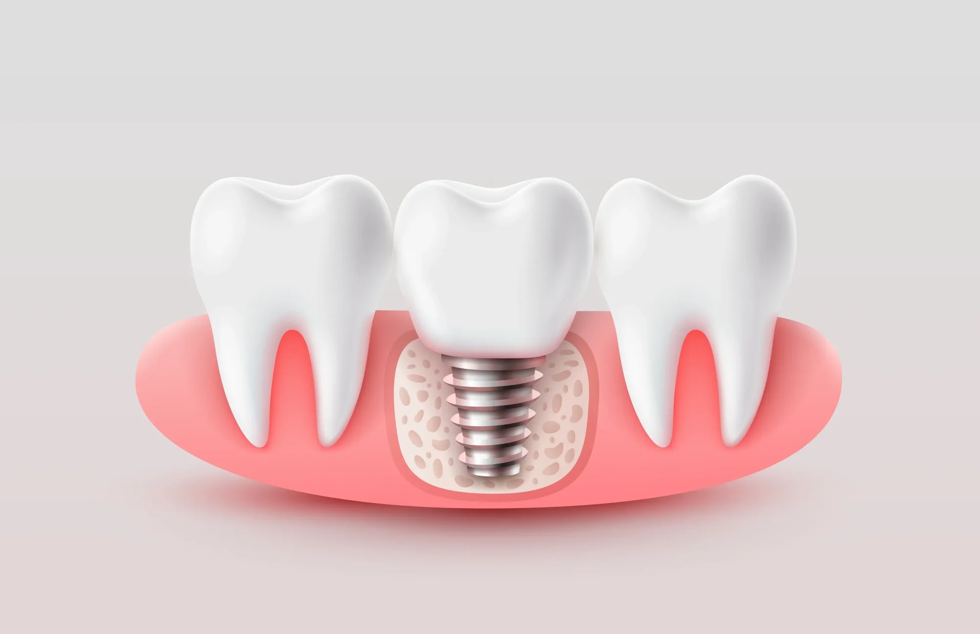 Same Day Dental Implants: What Is Actually Possible in One Visit